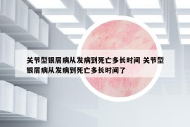 關(guān)節(jié)型銀屑病從發(fā)病到死亡多長(zhǎng)時(shí)間 關(guān)節(jié)型銀屑病從發(fā)病到死亡多長(zhǎng)時(shí)間了