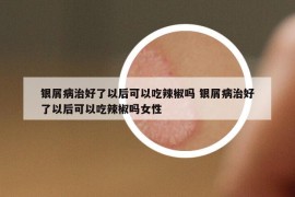 銀屑病治好了以后可以吃辣椒嗎 銀屑病治好了以后可以吃辣椒嗎女性