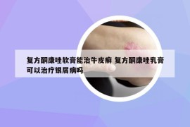 復(fù)方酮康唑軟膏能治牛皮癬 復(fù)方酮康唑乳膏可以治療銀屑病嗎