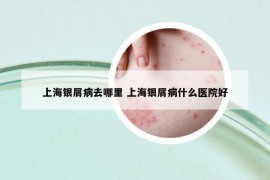 上海銀屑病去哪里 上海銀屑病什么醫(yī)院好
