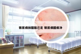 銀屑病抹醋酸已定 銀屑病醋癬凈