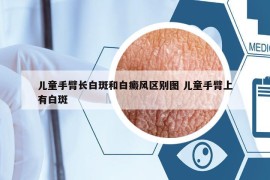 兒童手臂長白斑和白癜風(fēng)區(qū)別圖 兒童手臂上有白斑