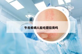 牛皮癬病人能吃蘑菇類嗎