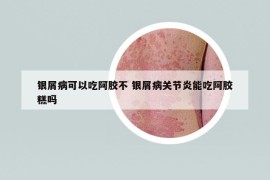 銀屑病可以吃阿膠不 銀屑病關節(jié)炎能吃阿膠糕嗎