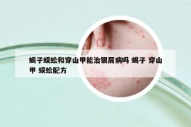蝎子蜈蚣和穿山甲能治銀屑病嗎 蝎子 穿山甲 蜈蚣配方