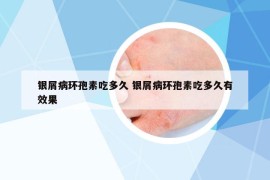 銀屑病環(huán)孢素吃多久 銀屑病環(huán)孢素吃多久有效果
