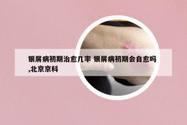 銀屑病初期治愈幾率 銀屑病初期會(huì)自愈嗎 ,北京京科