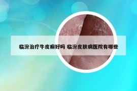 臨汾治療牛皮癬好嗎 臨汾皮膚病醫(yī)院有哪些