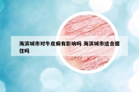 海濱城市對(duì)牛皮癬有影響嗎 海濱城市適合居住嗎