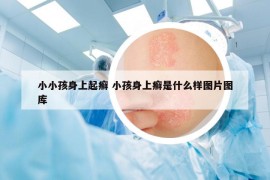 小小孩身上起癬 小孩身上癬是什么樣圖片圖庫