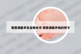 銀屑病最早出自哪本書 銀屑病最開始的樣子