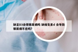 缺乏D3會(huì)得銀屑病嗎 缺維生素d 會(huì)導(dǎo)致銀屑病不愈嗎?