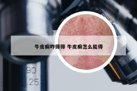 牛皮癬咋得得 牛皮癬怎么能得