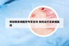 衡陽銀屑病醫(yī)院專家咨詢 衡陽治療皮膚病醫(yī)院