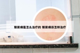 銀屑病是怎么治療的 銀屑病該怎樣治療
