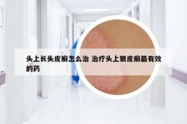 頭上長頭皮癬怎么治 治療頭上銀皮癬最有效的藥
