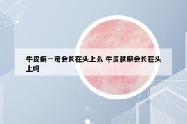 牛皮癬一定會(huì)長(zhǎng)在頭上么 牛皮膚癬會(huì)長(zhǎng)在頭上嗎