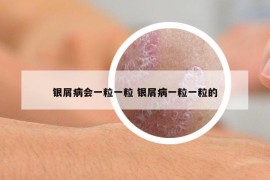 銀屑病會(huì)一粒一粒 銀屑病一粒一粒的