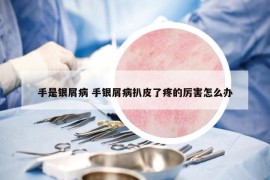 手是銀屑病 手銀屑病扒皮了疼的厲害怎么辦