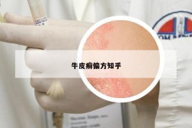 牛皮癬偏方知乎