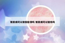 銀屑病可以做俯臥撐嗎 銀屑病可以鍛煉嗎