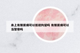 身上有銀屑病可以拒絕拘留嗎 有銀屑病可以當(dāng)警察嗎