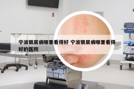 寧波銀屑病哪里看得好 寧波銀屑病哪里看得好的醫(yī)院