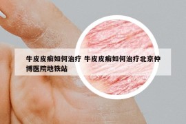 牛皮皮癬如何治療 牛皮皮癬如何治療北京仲博醫(yī)院地鐵站