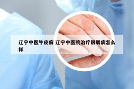遼寧中醫(yī)牛皮癬 遼寧中醫(yī)院治療銀屑病怎么樣