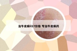 治牛皮癬il17價格 專治牛皮癬藥