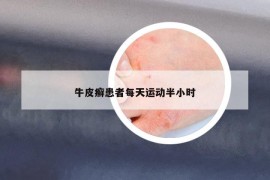 牛皮癬患者每天運(yùn)動半小時