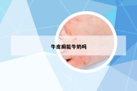 牛皮癬能牛奶嗎