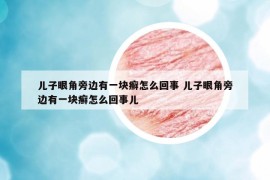 兒子眼角旁邊有一塊癬怎么回事 兒子眼角旁邊有一塊癬怎么回事兒