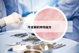 牛皮癬的神效秘方
