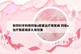 如何科學(xué)利用阿維a膠囊治療銀屑病 阿維a治療銀屑病多久有效果