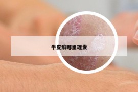 牛皮癬哪里理發(fā)