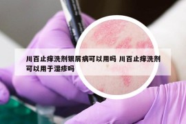 川百止癢洗劑銀屑病可以用嗎 川百止癢洗劑可以用于濕疹嗎