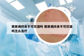 銀屑病終身不可飲酒嗎 銀屑病終身不可飲酒嗎怎么治療