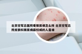 北京空軍總醫(yī)院看銀屑病怎么樣 北京空軍總院皮膚科銀屑病最權(quán)威的人是誰