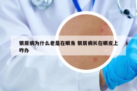 銀屑病為什么老是在眼角 銀屑病長在眼皮上咋辦