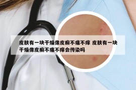 皮膚有一塊干燥像皮癬不痛不癢 皮膚有一塊干燥像皮癬不痛不癢會傳染嗎