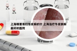 上海哪里有打牛皮癬的針 上海治療牛皮膚癬最好的醫(yī)院