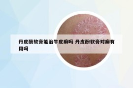 丹皮酚軟膏能治牛皮癬嗎 丹皮酚軟膏對癬有用嗎