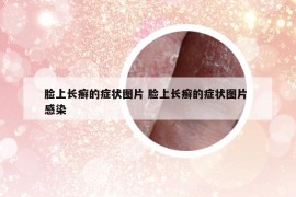 臉上長(zhǎng)癬的癥狀圖片 臉上長(zhǎng)癬的癥狀圖片 感染