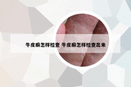 牛皮癬怎樣檢查 牛皮癬怎樣檢查出來(lái)
