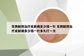 生物制劑治療皮膚病多少錢(qián)一針 生物制劑治療皮膚病多少錢(qián)一針多久打一次