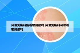 風(fēng)濕免疫科能看銀屑病嗎 風(fēng)濕免疫科可以看銀屑病嗎