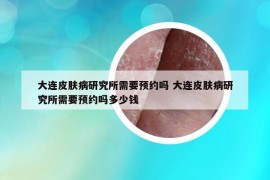 大連皮膚病研究所需要預(yù)約嗎 大連皮膚病研究所需要預(yù)約嗎多少錢