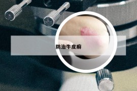防治牛皮癬