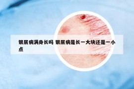 銀屑病滿身長(zhǎng)嗎 銀屑病是長(zhǎng)一大塊還是一小點(diǎn)